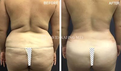 Tummy Tuck Before & After Gallery - Patient 287645 - Image 1