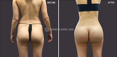 Brazilian Butt Lift Before & After Gallery - Patient 338566 - Image 1