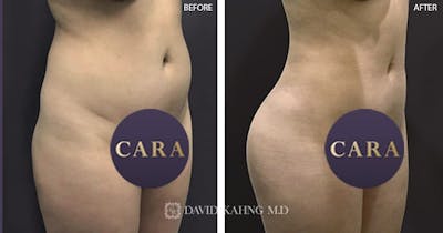 Brazilian Butt Lift Before & After Gallery - Patient 404049 - Image 1
