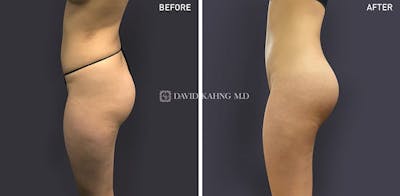 Brazilian Butt Lift Before & After Gallery - Patient 186811 - Image 1