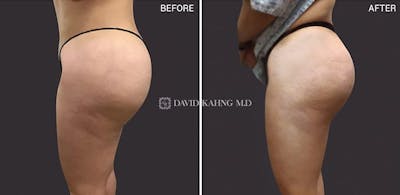 Brazilian Butt Lift Before & After Gallery - Patient 355029 - Image 1