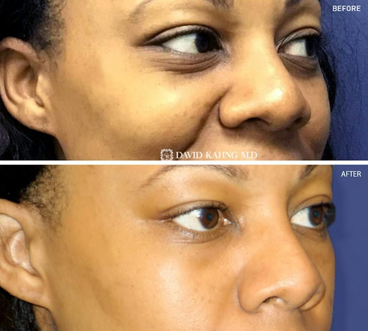 Filler Before & After Gallery - Patient 895170 - Image 1