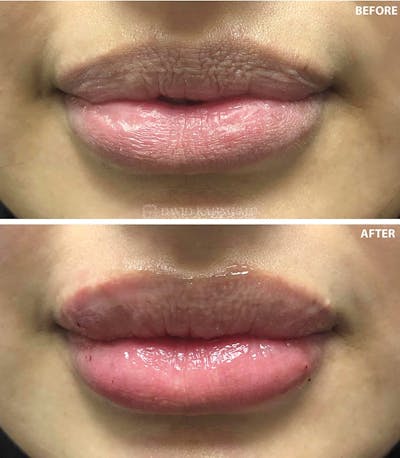 Filler Before & After Gallery - Patient 190799 - Image 1