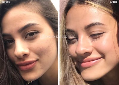 Laser Resurfacing Before & After Gallery - Patient 363241 - Image 1