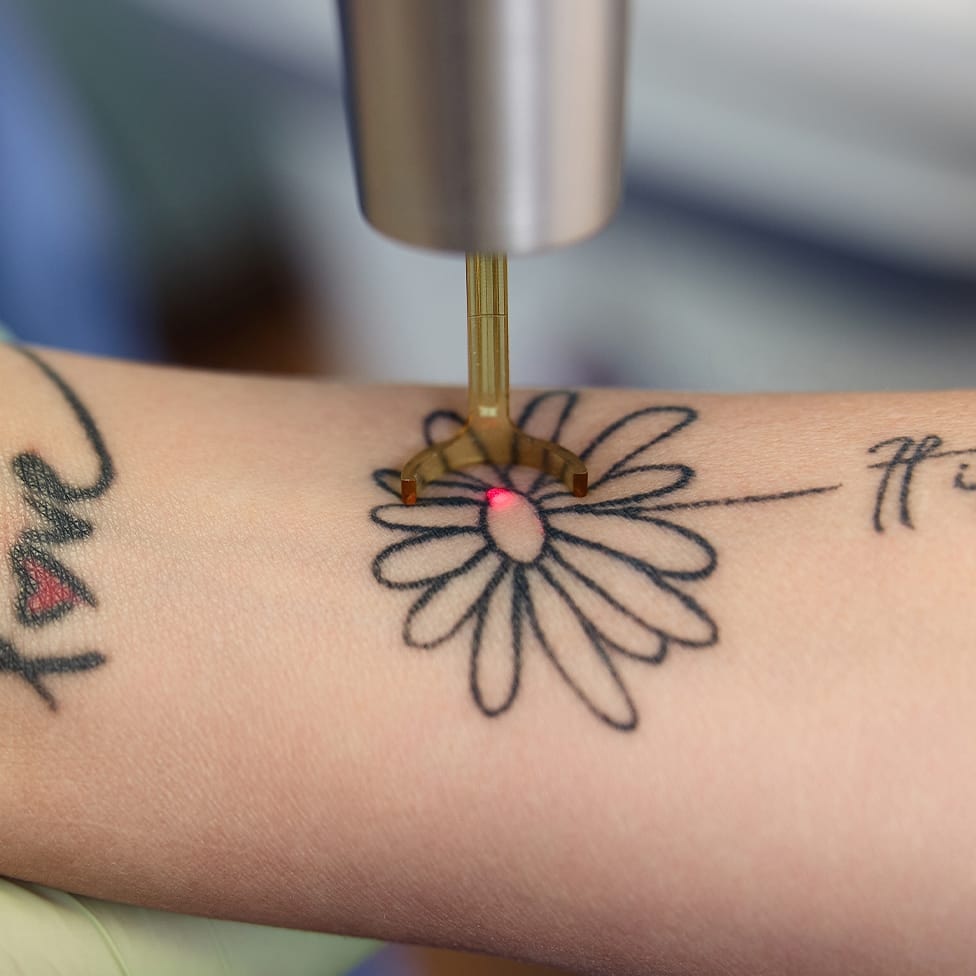 tattoo being lasered off