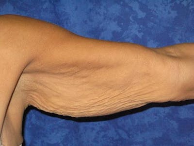 Brachioplasty (Arm Lift) Before & After Gallery - Patient 343273 - Image 1