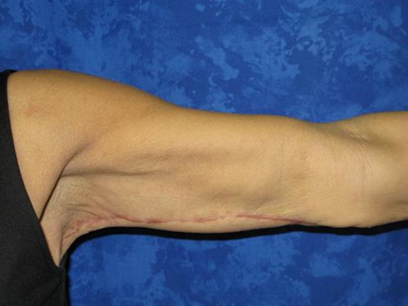 Brachioplasty (Arm Lift) Before & After Gallery - Patient 343273 - Image 2