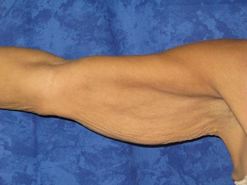 Brachioplasty (Arm Lift) Before & After Gallery - Patient 343273 - Image 3