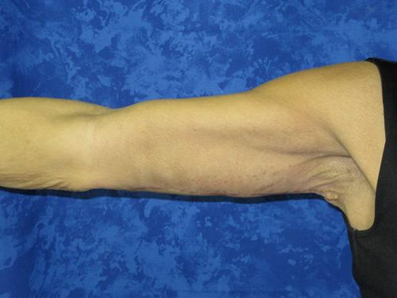 Brachioplasty (Arm Lift) Before & After Gallery - Patient 343273 - Image 4