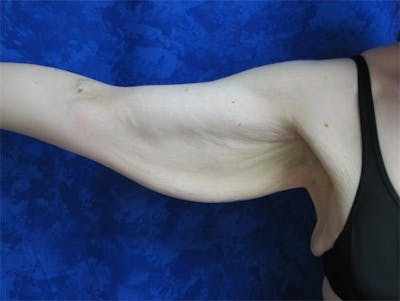 Brachioplasty (Arm Lift) Before & After Gallery - Patient 541067 - Image 1
