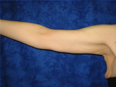 Brachioplasty (Arm Lift) Before & After Gallery - Patient 541067 - Image 2
