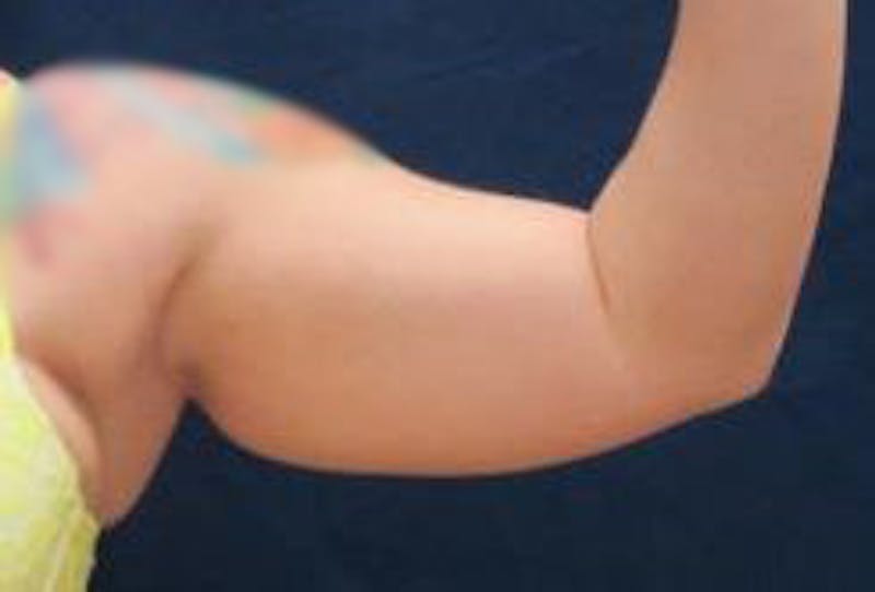 Brachioplasty (Arm Lift) Before & After Gallery - Patient 740030 - Image 1