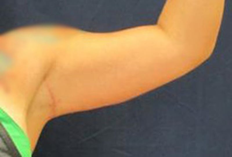 Brachioplasty (Arm Lift) Before & After Gallery - Patient 740030 - Image 2