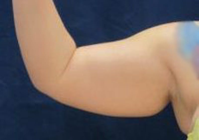 Brachioplasty (Arm Lift) Before & After Gallery - Patient 740030 - Image 3