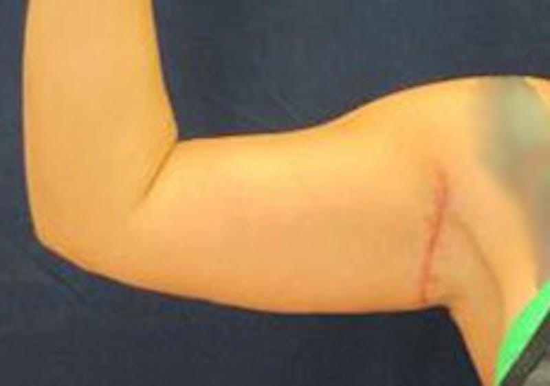 Brachioplasty (Arm Lift) Before & After Gallery - Patient 740030 - Image 4
