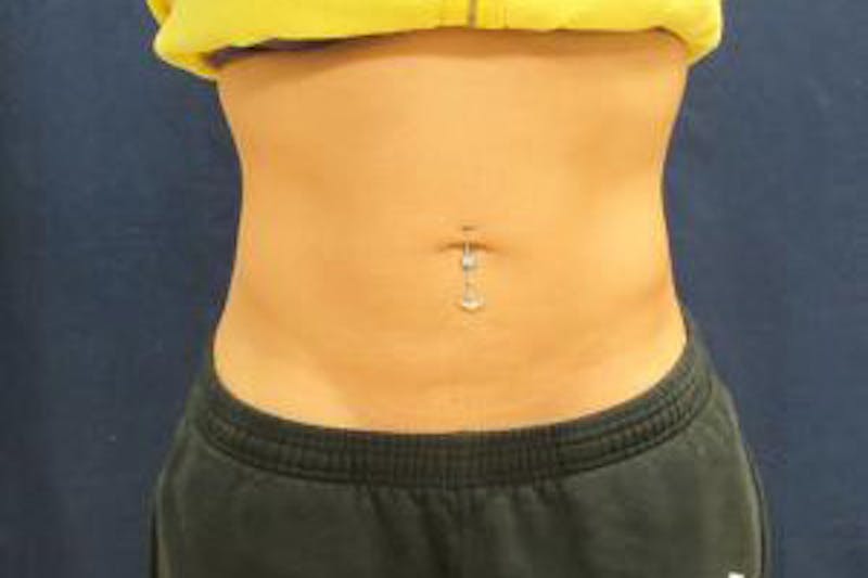 Liposuction Before & After Gallery - Patient 309571 - Image 2