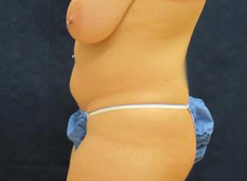 Liposuction Before & After Gallery - Patient 309571 - Image 3