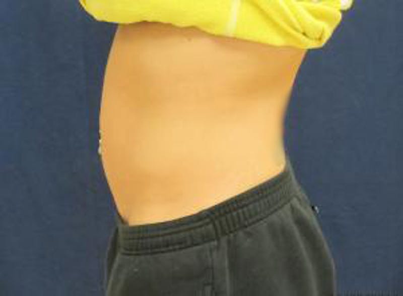Liposuction Before & After Gallery - Patient 309571 - Image 4