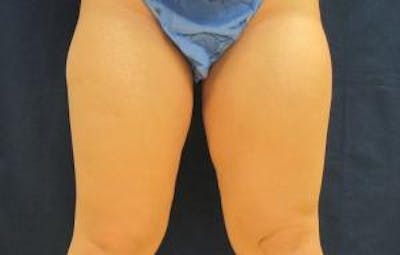 Liposuction Before & After Gallery - Patient 255092 - Image 1