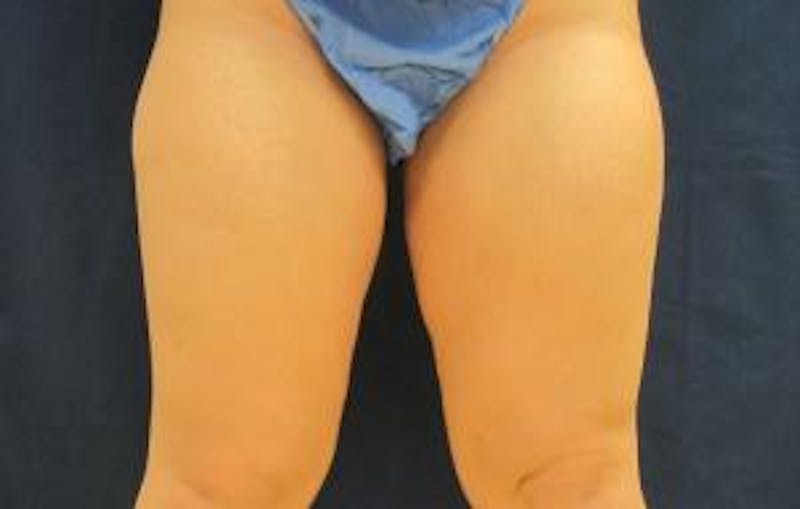 Liposuction Before & After Gallery - Patient 255092 - Image 1