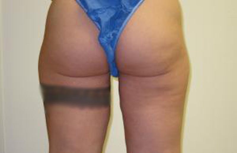 Liposuction Before & After Gallery - Patient 255092 - Image 4