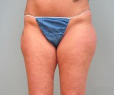 Liposuction Before & After Gallery - Patient 379492 - Image 1