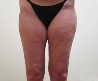 Liposuction Before & After Gallery - Patient 379492 - Image 2