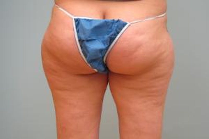 Liposuction Before & After Gallery - Patient 379492 - Image 3