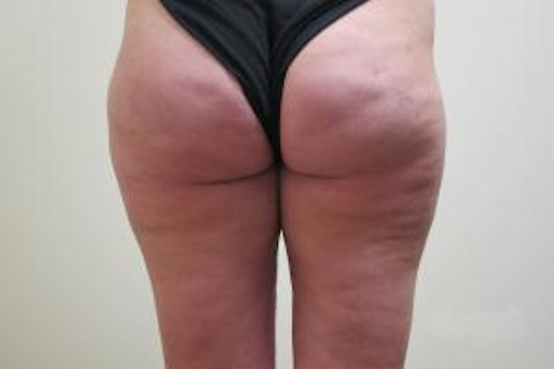 Liposuction Before & After Gallery - Patient 379492 - Image 4