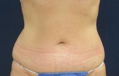 Liposuction Before & After Gallery - Patient 735563 - Image 1
