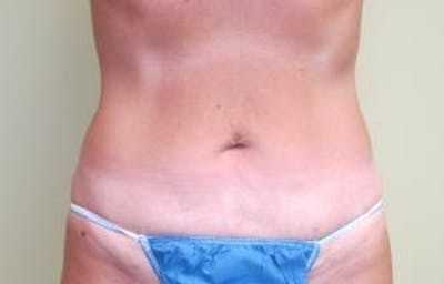 Liposuction Before & After Gallery - Patient 735563 - Image 2