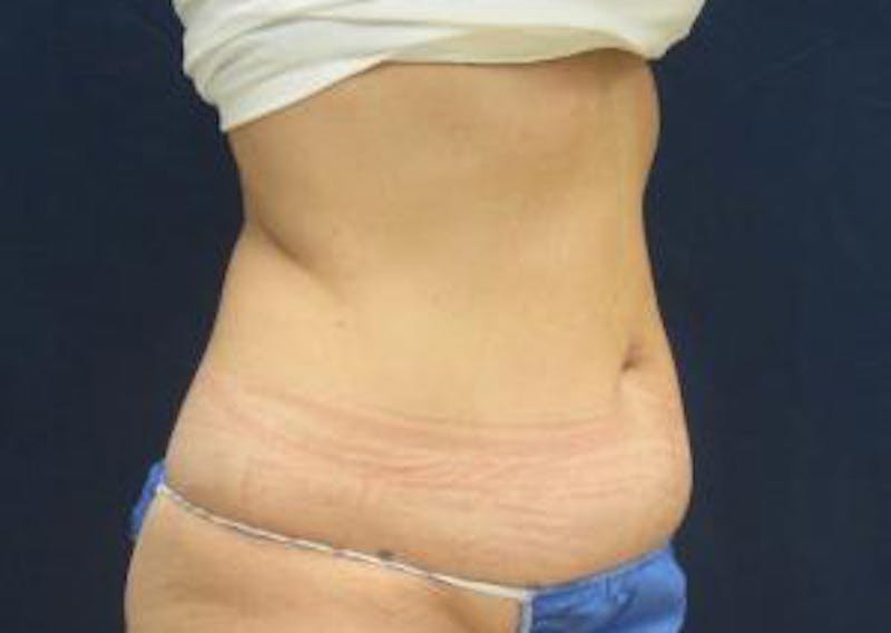 Liposuction Before & After Gallery - Patient 735563 - Image 3