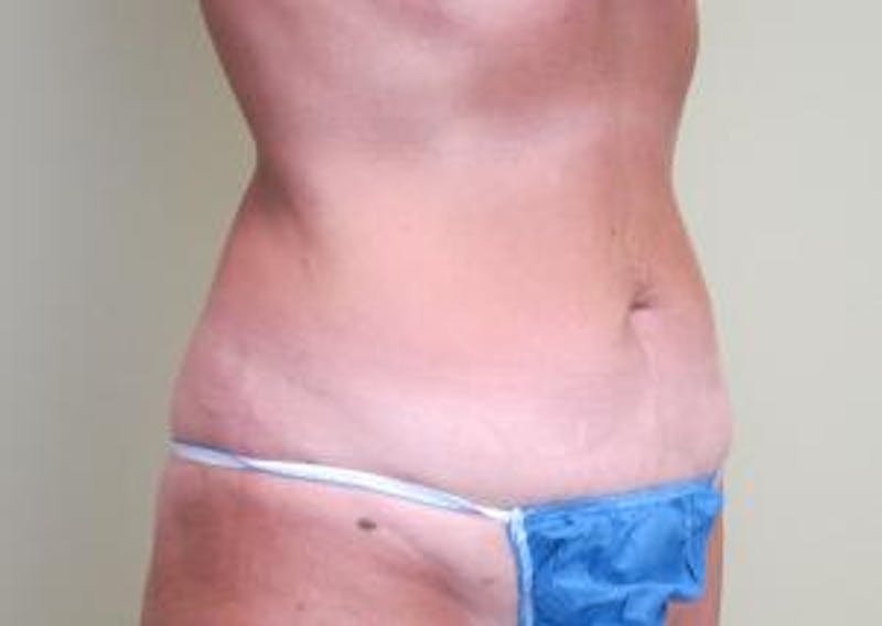 Liposuction Before & After Gallery - Patient 735563 - Image 4