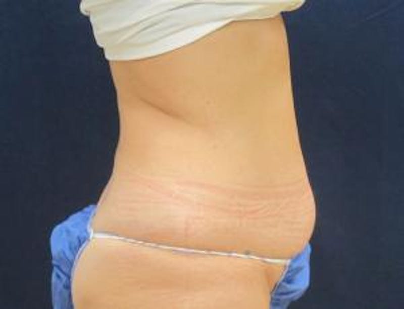 Liposuction Before & After Gallery - Patient 735563 - Image 5