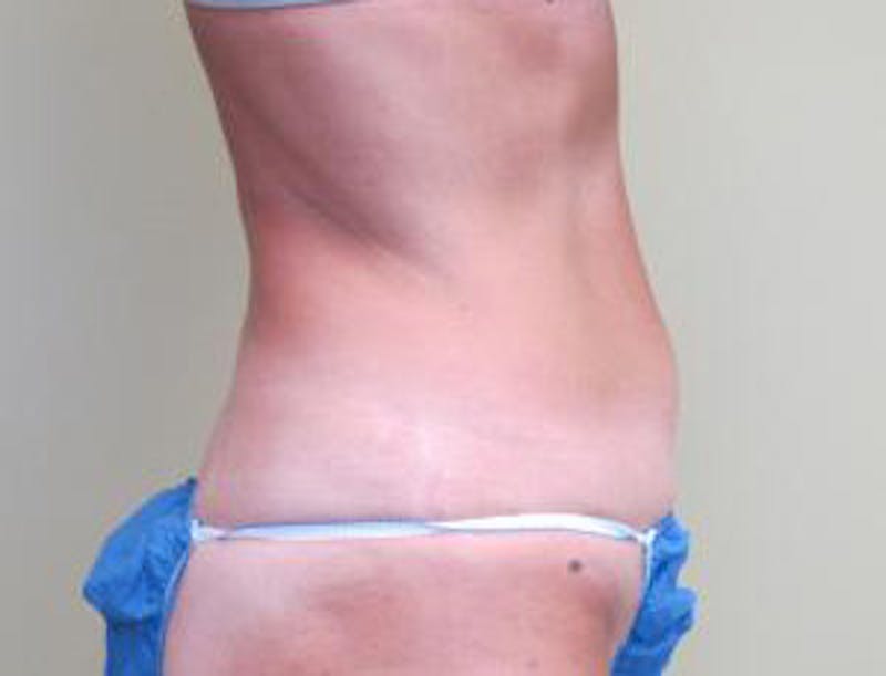 Liposuction Before & After Gallery - Patient 735563 - Image 6