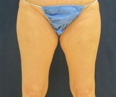Liposuction Before & After Gallery - Patient 420514 - Image 1