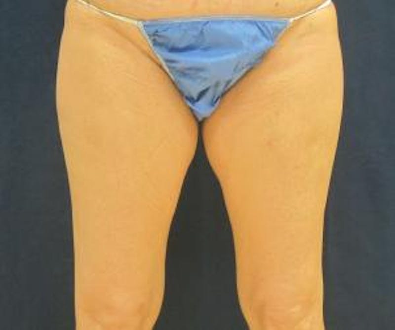 Liposuction Before & After Gallery - Patient 420514 - Image 1
