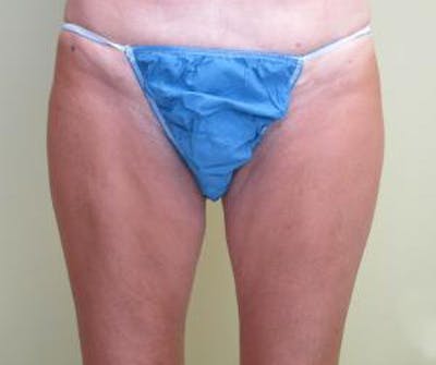 Liposuction Before & After Gallery - Patient 420514 - Image 2