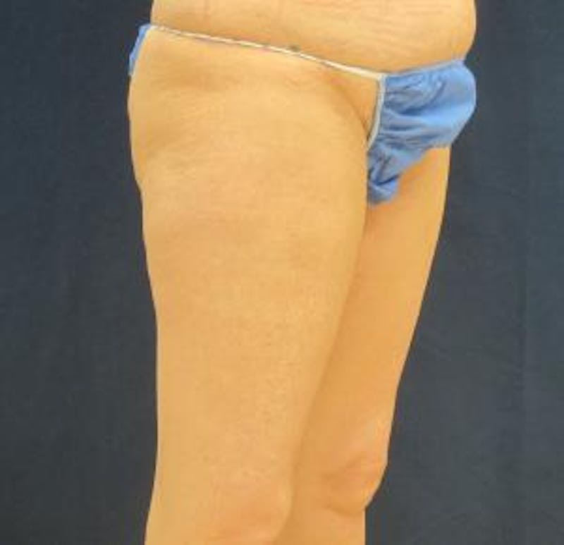 Liposuction Before & After Gallery - Patient 420514 - Image 3