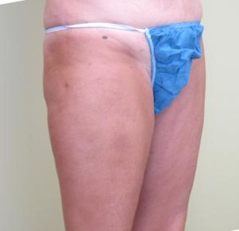 Liposuction Before & After Gallery - Patient 420514 - Image 4