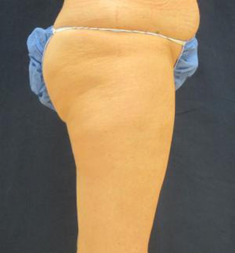 Liposuction Before & After Gallery - Patient 420514 - Image 5