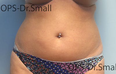 Liposuction Before & After Gallery - Patient 292276 - Image 1