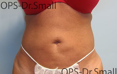 Liposuction Before & After Gallery - Patient 292276 - Image 2