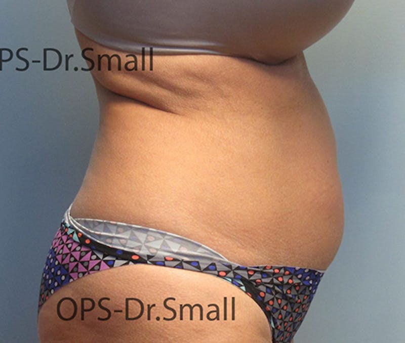 Liposuction Before & After Gallery - Patient 292276 - Image 3