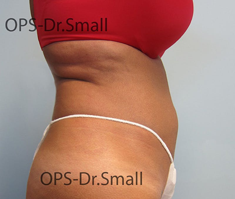 Liposuction Before & After Gallery - Patient 292276 - Image 4
