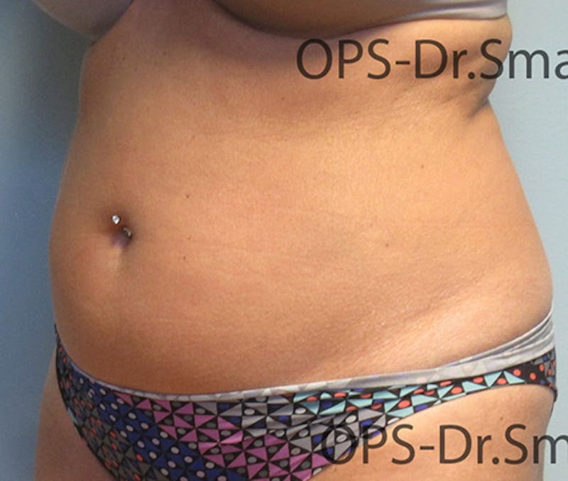 Liposuction Before & After Gallery - Patient 292276 - Image 5