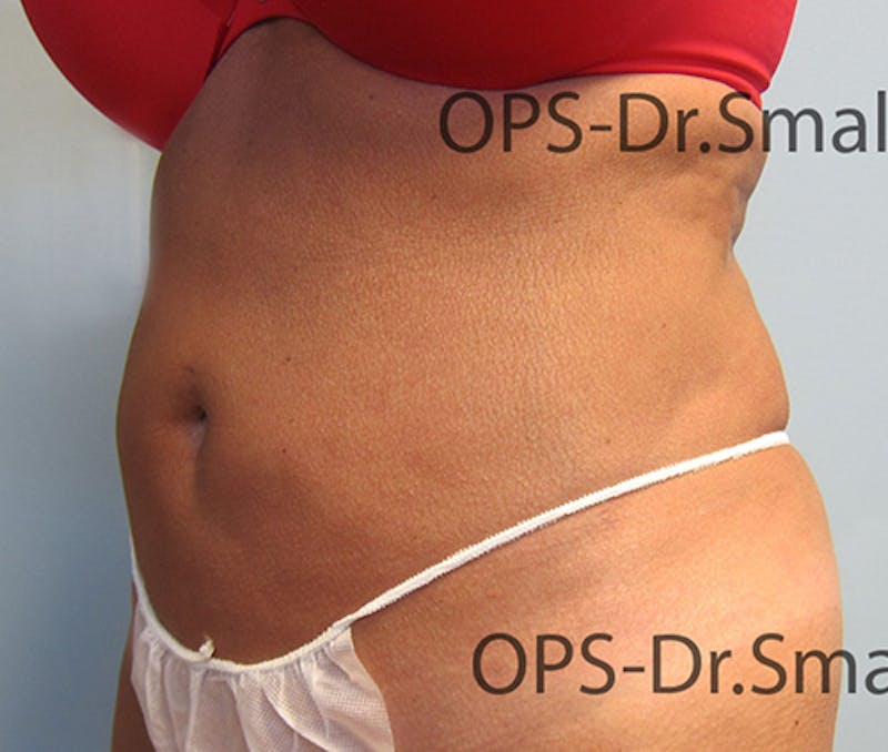 Liposuction Before & After Gallery - Patient 292276 - Image 6