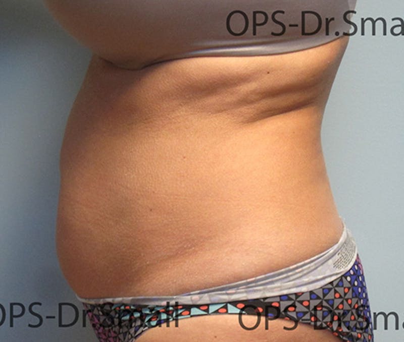 Liposuction Before & After Gallery - Patient 292276 - Image 7