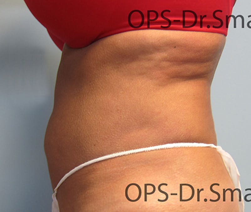 Liposuction Before & After Gallery - Patient 292276 - Image 8