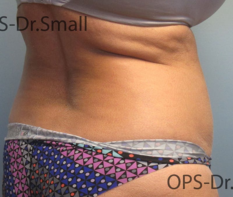 Liposuction Before & After Gallery - Patient 292276 - Image 9